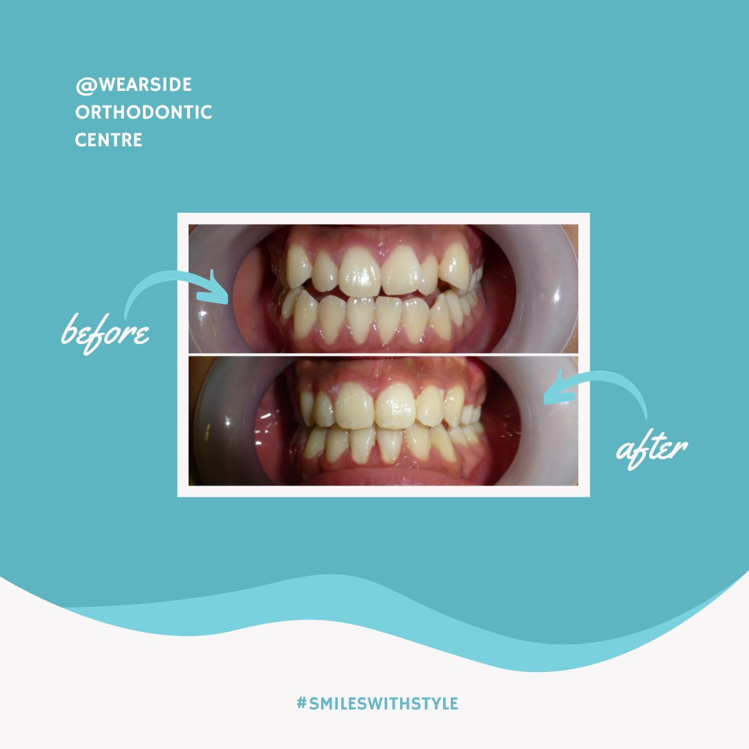 Experience the stunning transformation of our patients' smiles with our amazing fixed appliance magic! Don't settle for just a smile, let your smile gleam with confidence. Witness the remarkable before and after results. ✨ #SmileLikeYouMeanIt