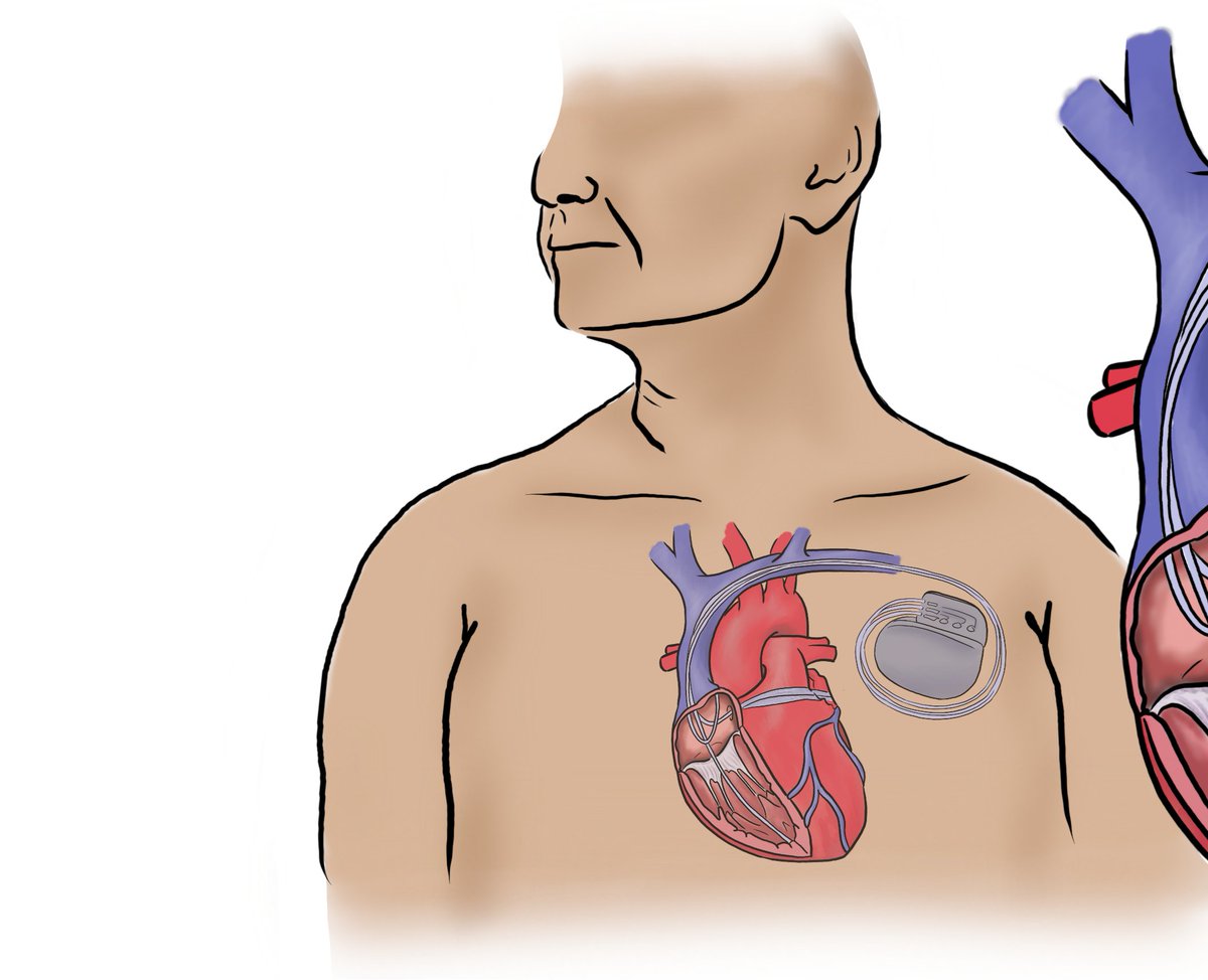 🚨Do older people (&gt;80 years) benefit from cardiac resynchronisation therapy as much as those who are younger?

Find out in our latest publication in <a href="/Age_and_Ageing/">Age_and_Ageing</a>: academic.oup.com/ageing/article… 

👩‍🎨Image credits to my lovely friend Ria Gadani

1/6