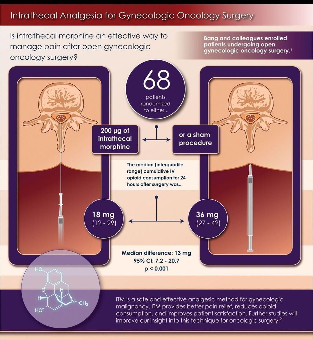 snwhealth's tweet image. "Deconstructing Postoperative Analgesia for Gynecologic Malignancy Surgery: Stand-Alone Intrathecal Morphine "

link -
pubmed.ncbi.nlm.nih.gov/37590797/

#Anesthesia
#surgical
#snwhealth
#snwareresearch