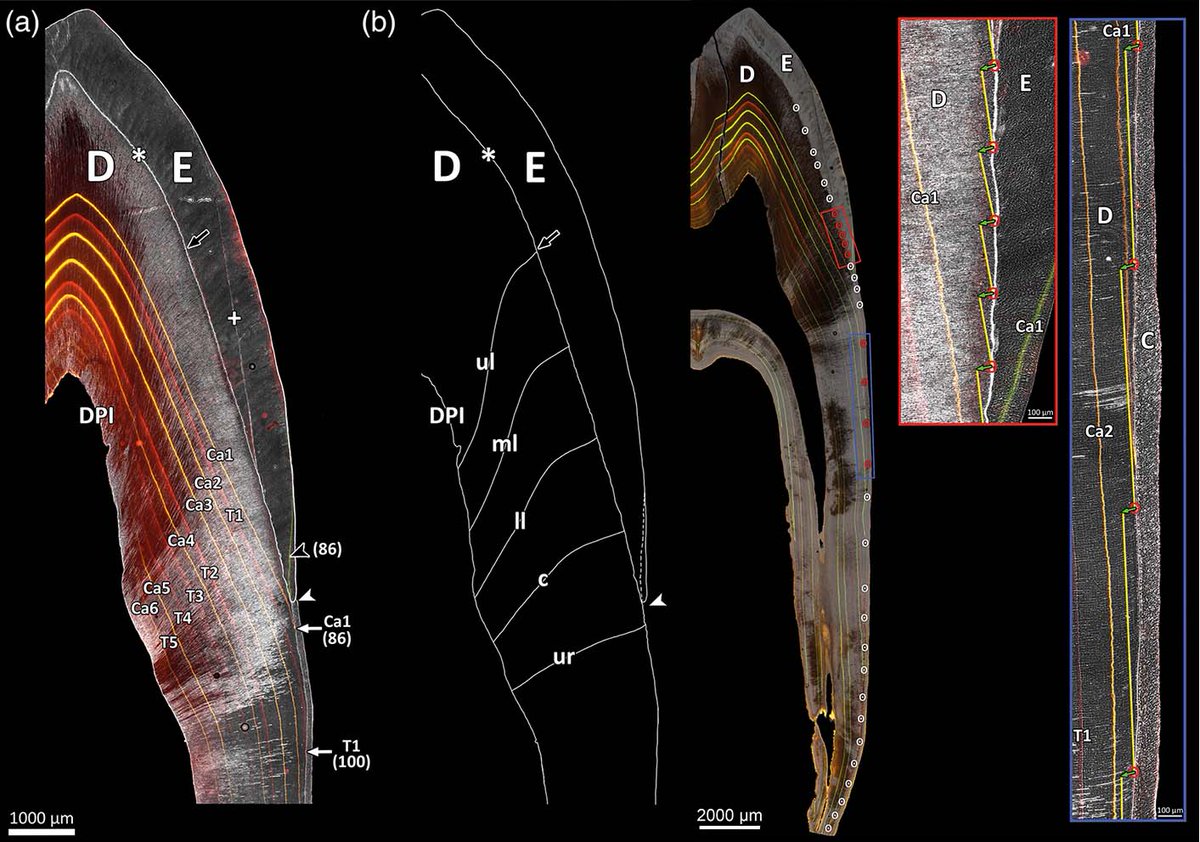 Tooth formation in wild boar &amp; domestic pigs reveals fascinating differences! Dentin apposition rates vary across zones. Root growth spurt timing &amp; rates differ b/w them, hinting at impact of domestication on odontoblast recruitment.
Emken et al.: doi.org/10.1002/ar.253…