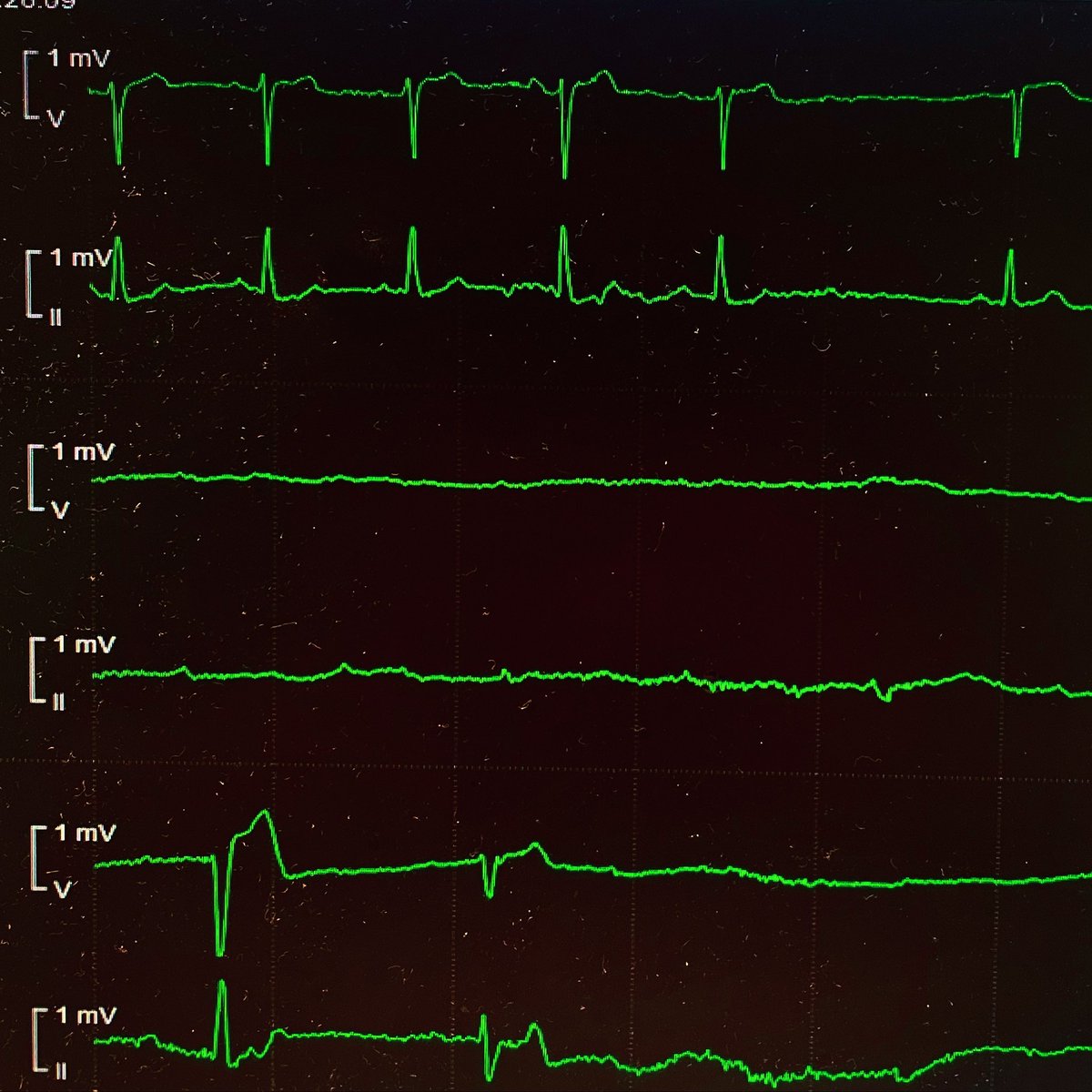 mmaturanaMD's tweet photo. What is happening? #epeeps #phaseIV #AVblock https://t.co/Mny7ijby45