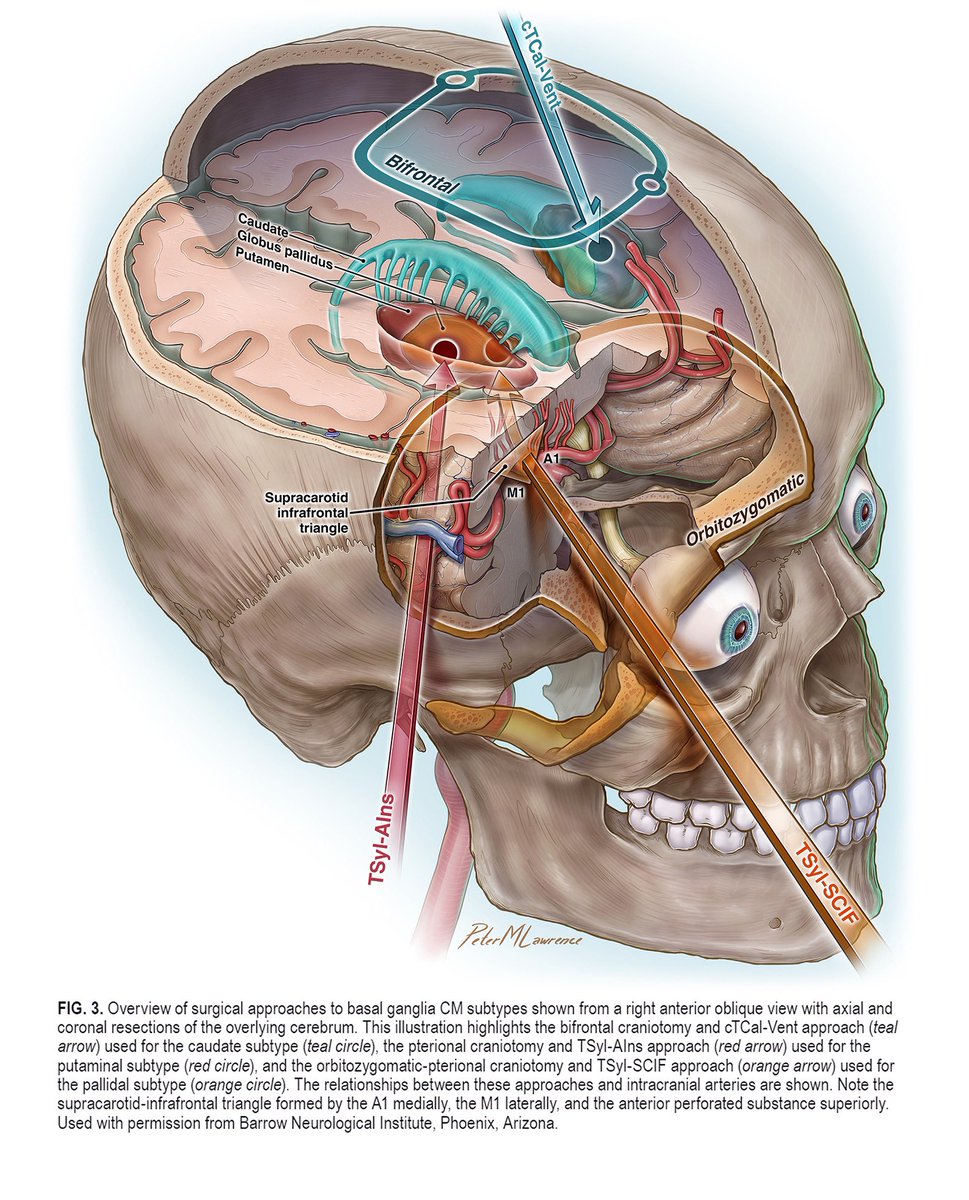 Excited to see this published: overview of surgical approaches to basal ganglia cavernoma subtypes. Article available online: doi.org/10.3171/2023.7…
@TheJNS @mtlawton @BarrowNeuro @OGdukeneurosurg #neuroscience #MedEd