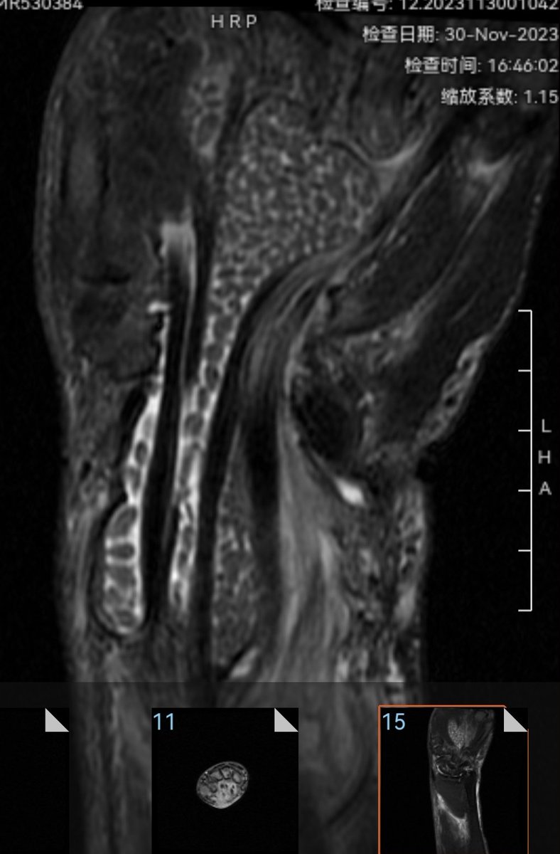 60y old man with wrist swelling for weeks. What's the diagnosis?