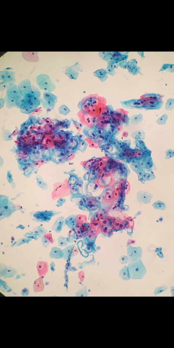 Plethoric L-SIL with syncytium of koilocytes. 26 years, #virus Hpv positive (non 18/45) #gynpath #cytopath