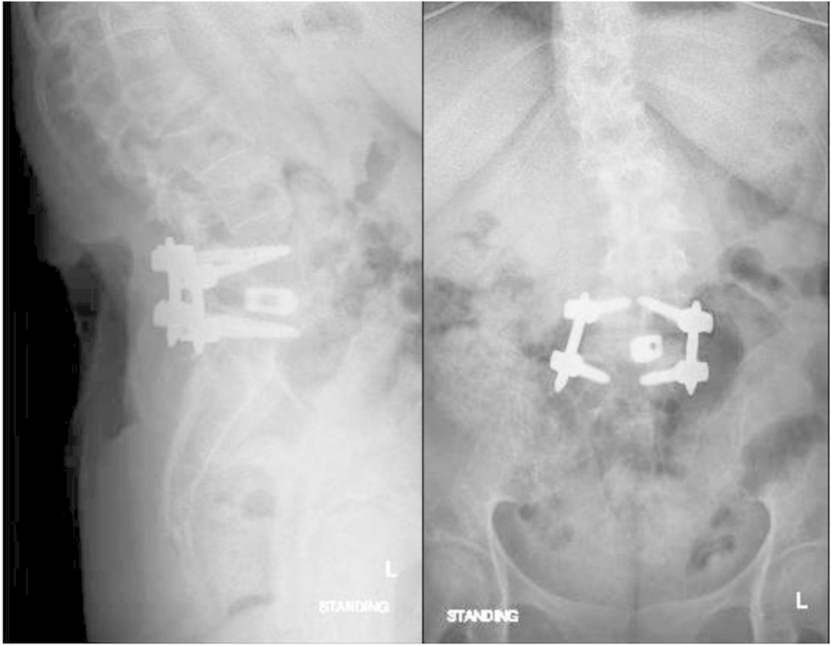 Postsurgical Pyoderma Gangrenosum After Minimally Invasive Transforaminal Lumbar Interbody Fusion
#spine #infection #ethics

tinyurl.com/2taznvc7