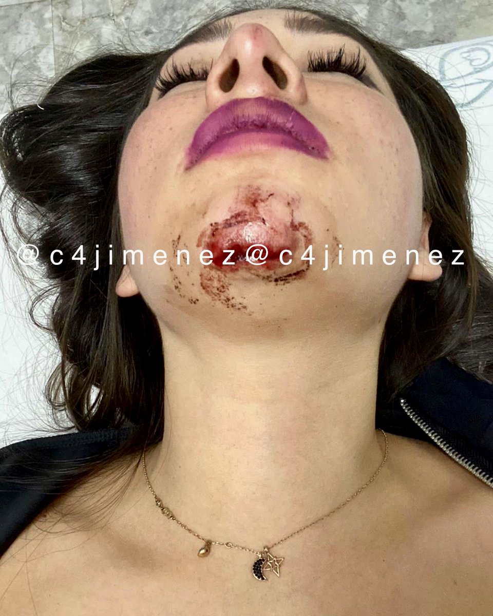CUIDADO
con este tipo
Es Carlos Santana
Trabaja en Bombay Roma Club en <a href="/AlcCuauhtemocMx/">Alcaldía Cuauhtémoc</a>
Así dejó herida a Selene.
Discutió con ella afuera del bar, la empujó por la espalda, la aventó al piso…
El bar negó su relación.
Aunq sucedió hace 9 días la <a href="/FiscaliaCDMX/">Fiscalía CDMX</a> no lo ha detenido.