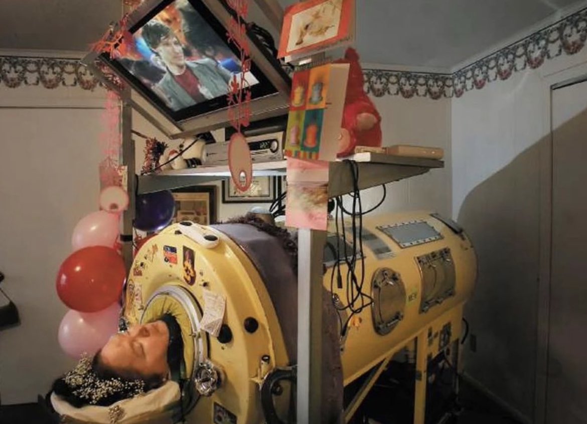 Diagnosed with polio at age 3, Dianne Odell had spent nearly 60 years encased in a 750-pound iron lung, only to die when a power outage shut down the machine that was keeping her alive.