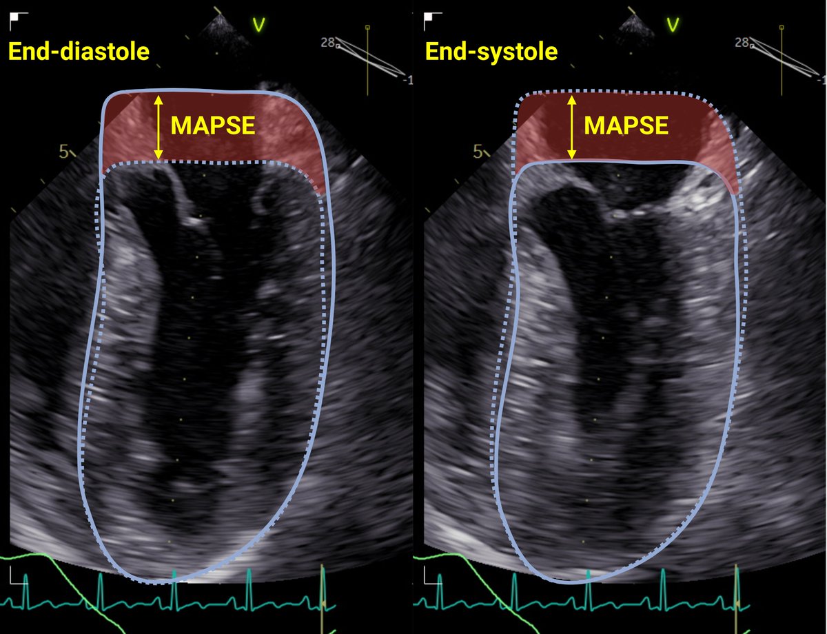 1/
#MAPSE: an unappreciated treasure for assessing LV function? #EchoFirst #WhyCMR

#MAPSE is easy and feasible in almost every patient, also in #ICU. It is highly prognostic, yet unpopular. The reasons are not rational.
🧵👇

#CardioTwitter #POCUS #FOAMed #MedTwitter