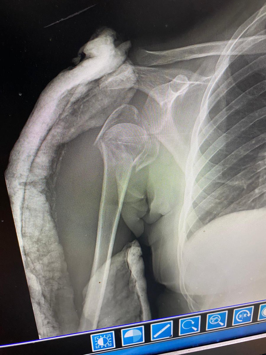 #مناشدة للمرة التانية،بترجاكم أي حدا بيقدر يساعدني أتواصل مع أي جهة طبية ممكن تخرج أختي من غزة لتقدر تعمل العملية،مريم مصابة من 45 يوم ولحتى هي اللحظة ما أجرت العملية وكتفها منتفخ ولونه مش طبيعي والوجع ما بتقدر تستحمله وما بتقدر تنام،بترجاكم ما تشوفوا الخبر وكأنه شي عادي بترجاكم.