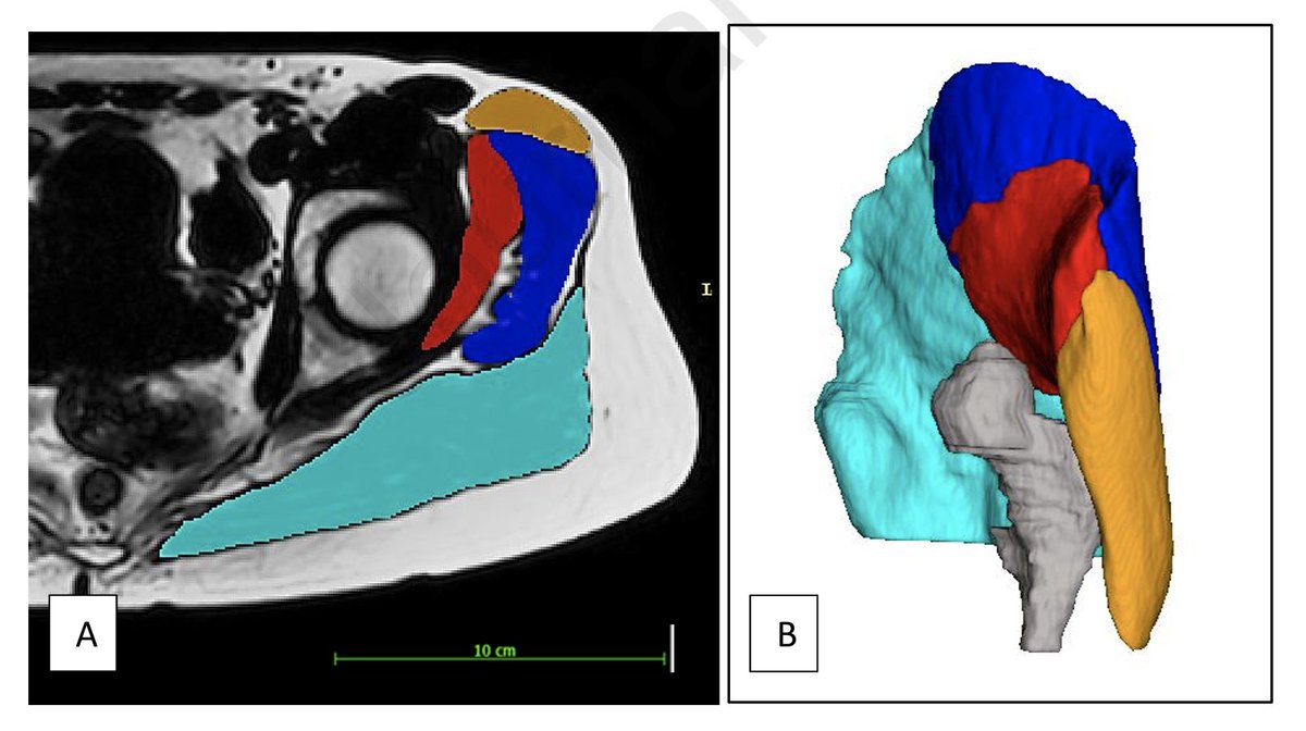 The association between lateral hip muscle size/intramuscular fat infiltration and hip strength in active young adults with long standing hip/groin pain

doi.org/10.1016/j.ptsp…
