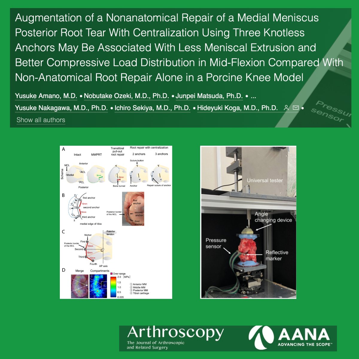 This biomechanical study at time zero suggests that the addition of centralization using 3 knotless anchors may reduce medial meniscus extrusion and restore the load-distributing function ow.ly/SLoN50QeRF3