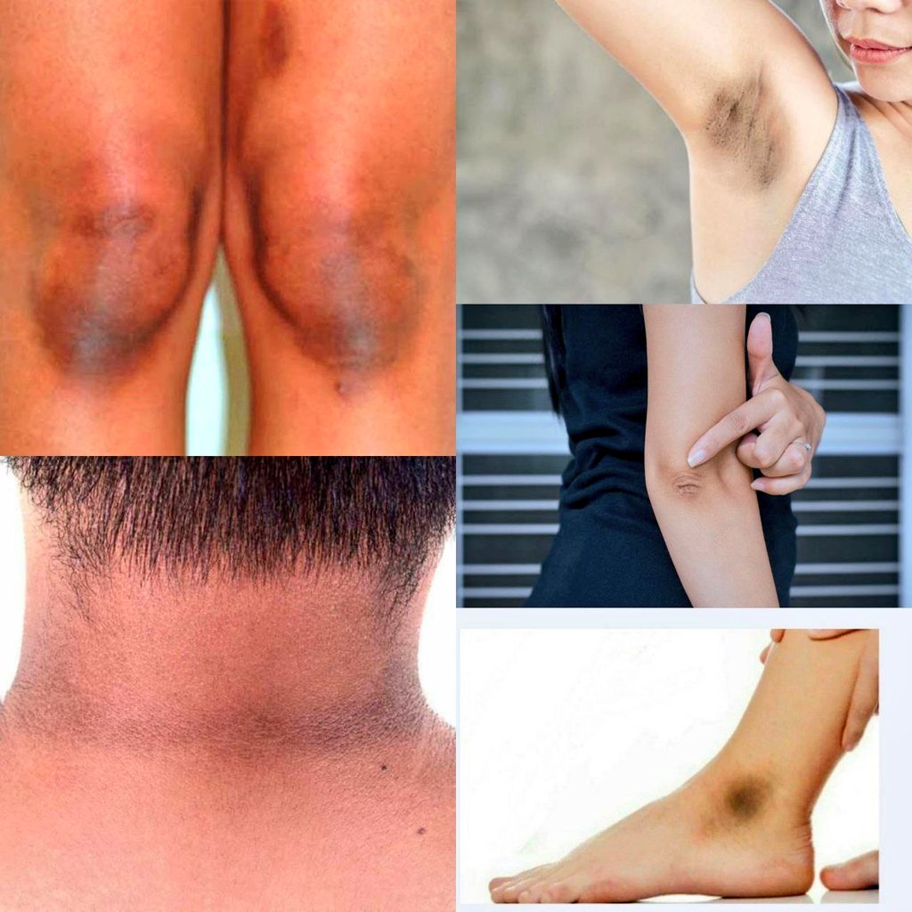 anymooreee's tweet image. Treatment Mencerahkan lipatan kulit gelap !

--A Thread--