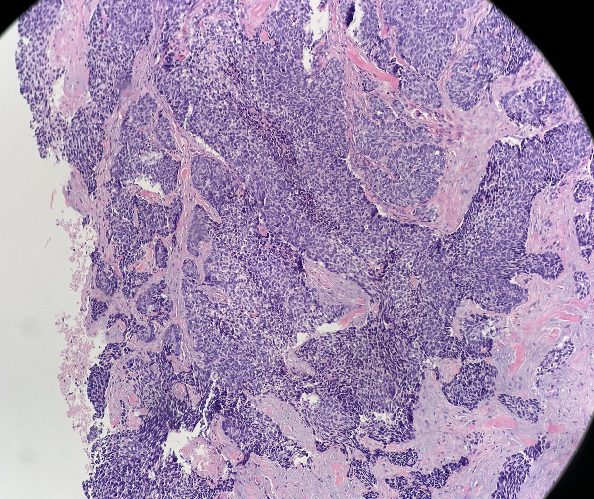 65 year old man posterior auricular neck deep dermal nodule. easy peezy?#dermpath #PathTwitter #dermatology  <a href="/et565/">Etan Marks, DO</a> @ArjunRamaiya1 <a href="/kis_lorand/">Lorand Kis</a> <a href="/DrGeeONE/">Olaleke Folaranmi</a> <a href="/TristanRutland7/">Tristan Rutland MBBS FRCPA IFCAP</a> <a href="/trishstratuscom/">Trish Stratus</a> <a href="/MarcelaSaebL/">Marcelasaeblima.</a> <a href="/redsnapperpath/">Allison Osmond MD MSc FRCPC</a> <a href="/AlomariDermpath/">Ahmed Alomari, MD</a> <a href="/gonzadetoro/">Gonzalo De Toro</a>