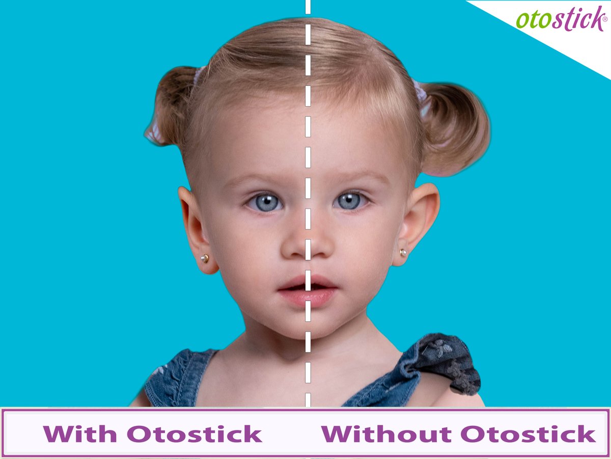 Use of Otostick is recommended from the age of 3, but some users prefer Otostick Baby given the characteristics of their own ears.

otostick.com

#otostick #OtostickBaby #earpinning #pinnedears #ears
