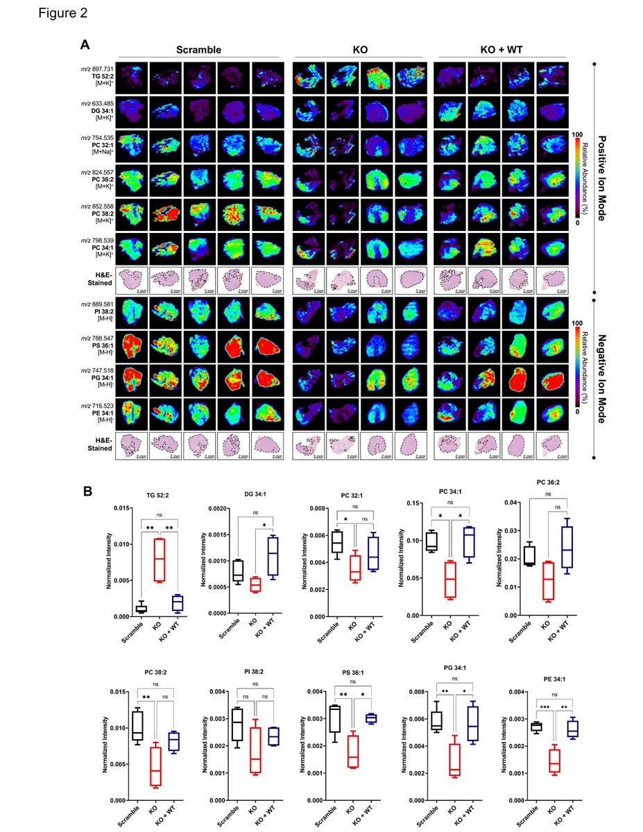 🔥New study from lab that found ATGL, a mediator of intracellular lipolysis, is 📈in mCRPC, regulated by #CAMKK2 #AMPK, and a druggable target for advanced #prostatecancer. Both lipolytic and non-lipolytic roles of ATGL are key. @MDAndersonNews @CR_AACR bit.ly/3NfF5az