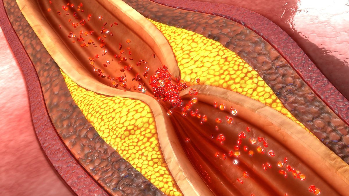 NewsMedical's tweet image. New genetic links to coronary artery calcification uncovered 🧬❤️🔬 news-medical.net/news/20231205/… #HeartHealth #GeneticResearch #CACStudy #Atherosclerosis #Cardiovascular #VascularHealth #Genetics #ArteryCalcification @NatureCVR