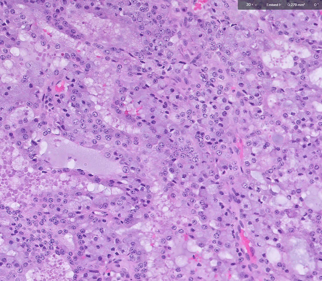 Neck mass #pathology #pathtwitter #surgpath #pathologyfamily @MayoPathology @Kenny92954457 @GeronimoJrLapac