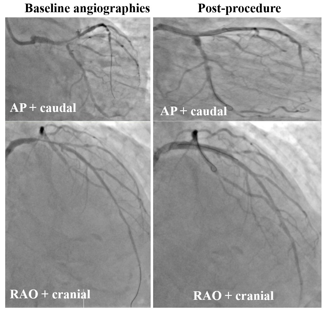 A 74-yr gentleman, UAP with DM/HP. Severe calcification with a nodule at ostial LCX. Predilation using NC + cutting balloon. DK crush. Difficult but successful 2nd rewiring into LCX. FFR-LCX = 0.80