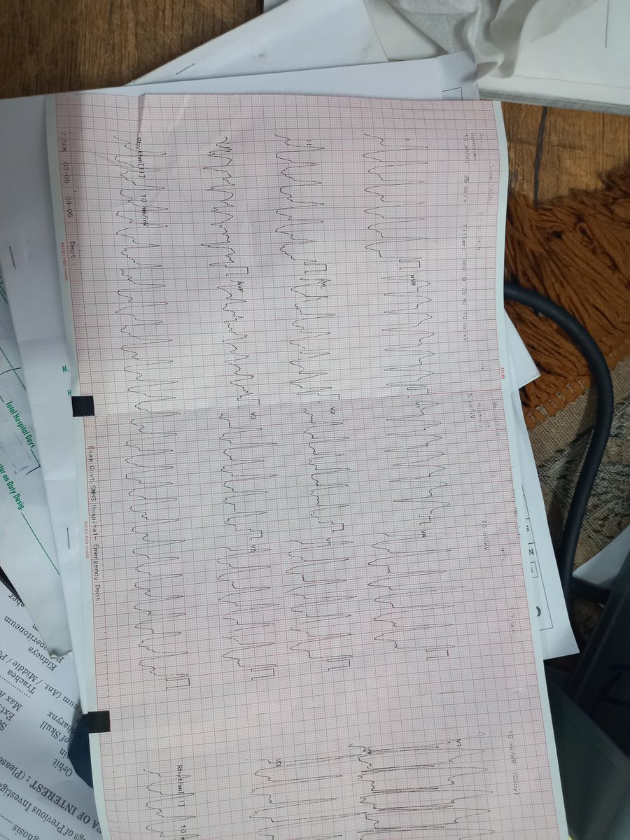 drowias's tweet photo. 29 year old male, k/c/o complex congenital heart disease (Dextrocardia with VSD)...came with sudden onset palpitations...(had fever/ cough 2 days back...taken levosolbutomol containing syp)..o/e gcs 15, pulse 180, BP 100/70 https://t.co/tQTfi9MBCu