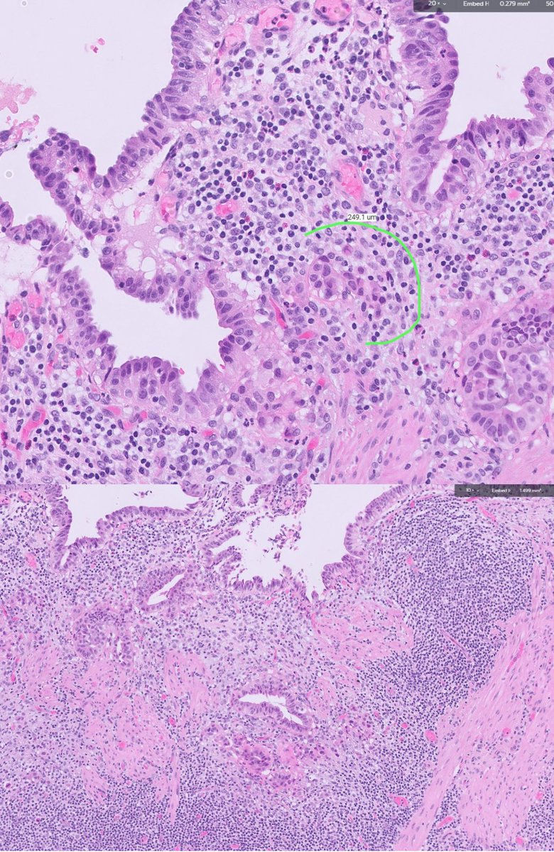 Gallbladder thickened wall #GIpath #surpath #pathtwitter #pathology #pathologyfamily @GeronimoJrLapac