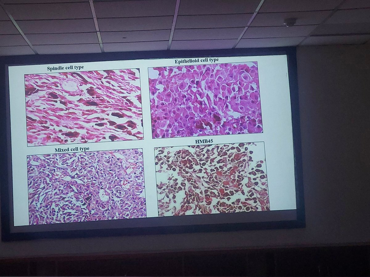ViralBhanvadia's tweet image. @Apcon2023 ,#APCON2023 ,#eyepath #occularpatho #headneckpath choroidal melanoma-update