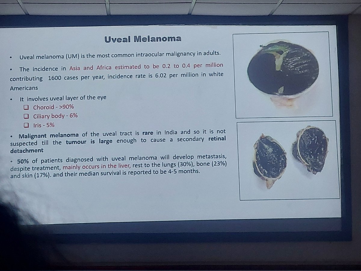 ViralBhanvadia's tweet image. @Apcon2023 ,#APCON2023 ,#eyepath #occularpatho #headneckpath choroidal melanoma-update