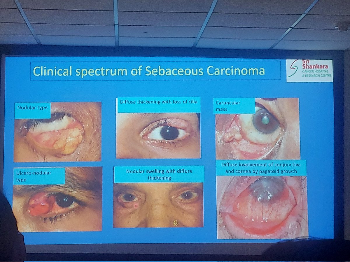ViralBhanvadia's tweet photo. @Apcon2023 ,#APCON2023 ,#eyepath #occularpatho #headneckpath #dermpath #skinpath sebaceous gland tumour https://t.co/dWk2jPiErq