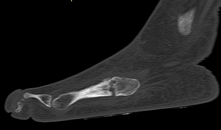 Non-healed fracture at the base of the 5th metatarsal, precisely at the metaphyseal-diaphyseal junction (Jones fracture), persists after 5 months. Radiological signs include the absence of cortical and medullary bone bridging and resorption and sclerosis of fracture ends #mskrad