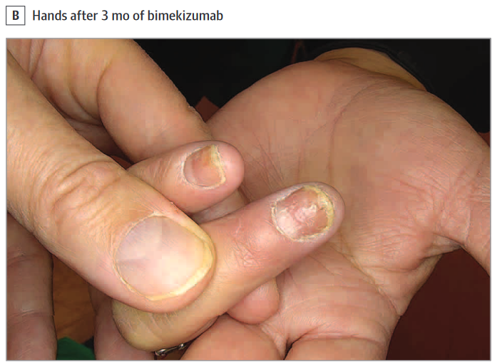 Findings of this case series suggest bimekizumab may be effective for treating PPP, palmoplantar plaque psoriasis with pustules, and SAPHO (synovitis, acne, pustulosis, hyperostosis, osteitis) syndrome. ja.ma/4167Axl #JDP2023