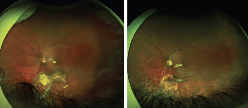 RetinaToday's tweet photo. Case Video: Complex repair of combined tractional/rhegmatogenous #retinaldetachment following plaque radiotherapy for choroidal melanoma. See how Drs. Jacob Light and Michael Klufas adopt a collaborative approach to treating this patient. https://t.co/4c7S3woS3p https://t.co/nNnRb2qr9N