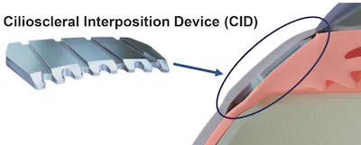 eyewireplus's tweet photo. .@cilia_tech announced the release of a new design of its #CID (cilioscleral interpositioning device) following the filing of additional patents strengthening its IP (intellectual property). https://t.co/nkg4C4brFE https://t.co/qDTZqx2ouS