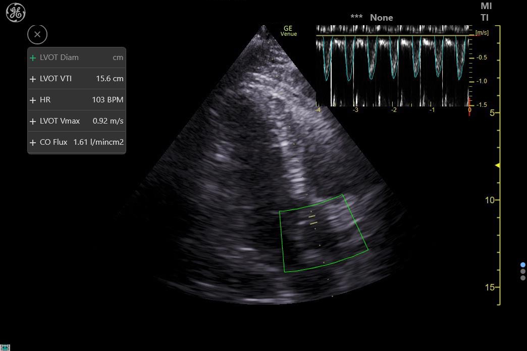 Love GE Healthcare's Auto-VTI tool! Applying it here to an apical 3-chamber ('long-axis') TTE view to assess volume responsiveness. Hoping to see more tools like this expand across manufacturers. #echofirst #pocus #ICU #medtwitter