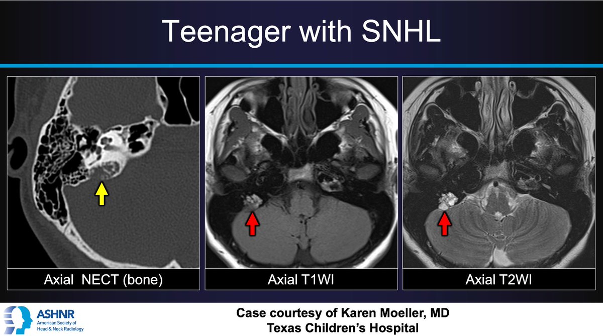 ASHNRSociety's tweet photo. #ASHNRCOTW #235 ANSWER: Endolymphatic sac tumor! Thx Dr. @pedsneurorad 4 case! #ASHNR24

@callyrobs @AshokSrini15 @DShatzkes @CDP_Rad @rhwiggins @nakoontz @KRileyMD @cmtomblinson @ESHNRSociety @CMGlastonbury @PhilipRChapman1 @tabby_kennedy @amyfjuliano @AnnJayMD1 @WmOBrienDO https://t.co/sWvBYXiaTi