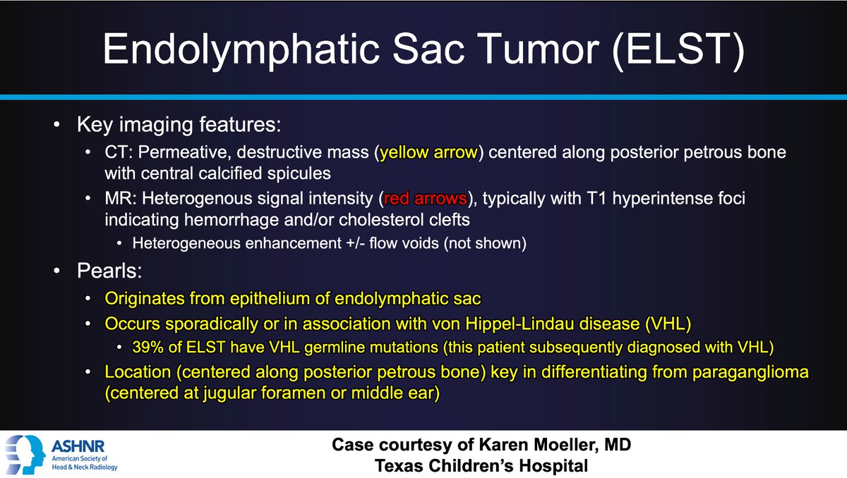 ASHNRSociety's tweet photo. #ASHNRCOTW #235 ANSWER: Endolymphatic sac tumor! Thx Dr. @pedsneurorad 4 case! #ASHNR24

@callyrobs @AshokSrini15 @DShatzkes @CDP_Rad @rhwiggins @nakoontz @KRileyMD @cmtomblinson @ESHNRSociety @CMGlastonbury @PhilipRChapman1 @tabby_kennedy @amyfjuliano @AnnJayMD1 @WmOBrienDO https://t.co/sWvBYXiaTi
