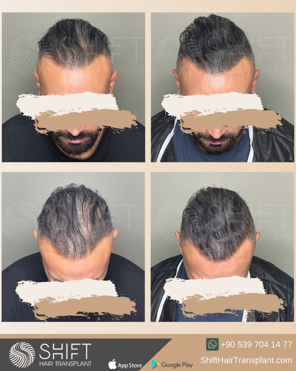 shifthairtr's tweet image. Before and after micropigmentation for density camouflage and donor area correction in Turkey with SHIFT Hair in Istanbul

#scalpmicropigmentation #micropigmentation #smp