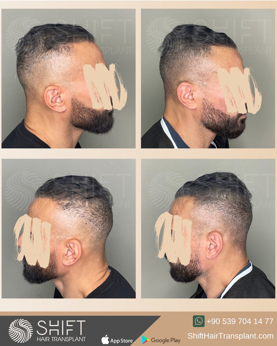 shifthairtr's tweet image. Before and after micropigmentation for density camouflage and donor area correction in Turkey with SHIFT Hair in Istanbul

#scalpmicropigmentation #micropigmentation #smp