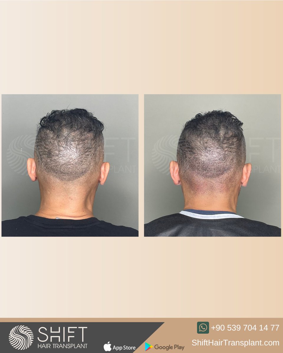 shifthairtr's tweet image. Before and after micropigmentation for density camouflage and donor area correction in Turkey with SHIFT Hair in Istanbul

#scalpmicropigmentation #micropigmentation #smp