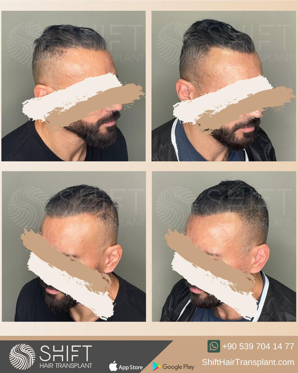 shifthairtr's tweet image. Before and after micropigmentation for density camouflage and donor area correction in Turkey with SHIFT Hair in Istanbul

#scalpmicropigmentation #micropigmentation #smp