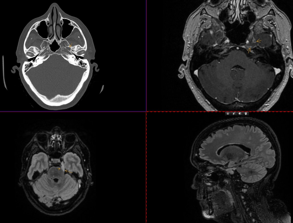 Hi #HnN Would kindly ask from some help here. 61F. T2 hyper mass in C. meckeli and widened F. ovale. It extends towards brainstem along V. Would gladely call it schwannoma but only smal foci of enhancement... <a href="/amyfjuliano/">Amy Juliano</a> <a href="/DShatzkes/">Deborah Shatzkes</a> <a href="/callyrobs/">Caroline Robson, MBChB</a> <a href="/LorenzoPinelli/">Lorenzo Pinelli</a>  <a href="/sureshmukherji/">Suresh Mukherji</a>