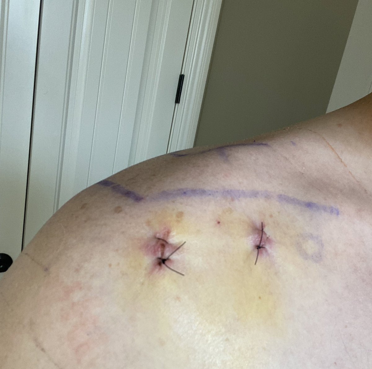 TheGreenOldDill's tweet photo. 6 days post-surgery on my shoulder:
#SLAPtear https://t.co/rKlQFWdrZ8