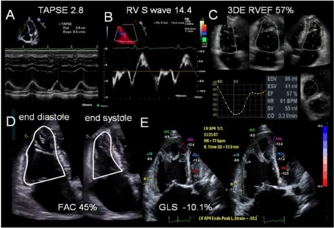 ZHeart11768530's tweet photo. Assessment of Right Ventricular Function—a State of the Art  #2023Review 
#Openaccess

https://t.co/AJX8qre1RN
#CardioTwitter #cardioEd #Cardiology https://t.co/L6vcHGlvFa