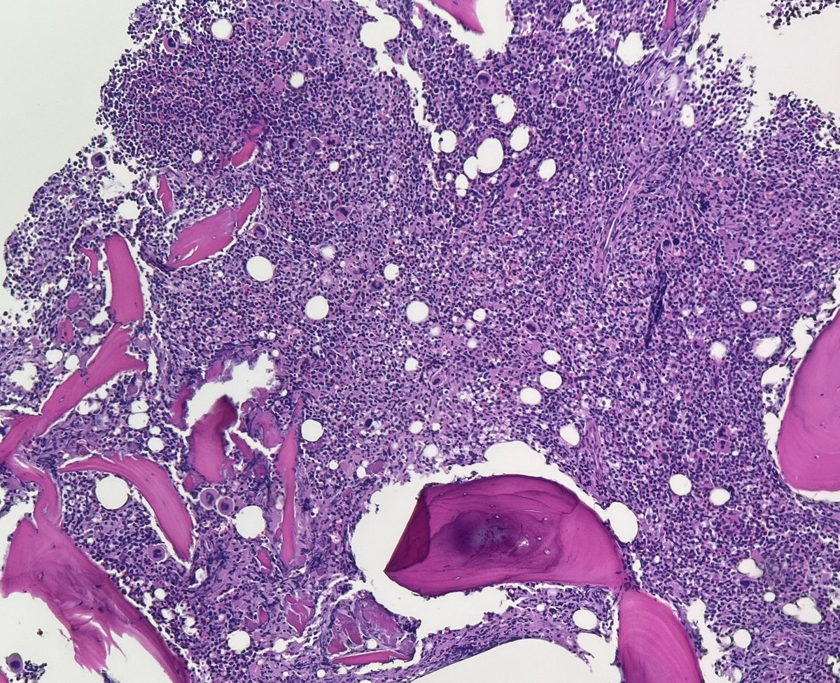 NanaMatsumoto8's tweet photo. Middle aged Caucasian female. No organomegaly. EBER, CD3 (sCD3 neg by flow), CD56 shown. CD4/8/5/7 neg. What do you think? ZP #PathTwitter #hemepath https://t.co/0FyQnyu294