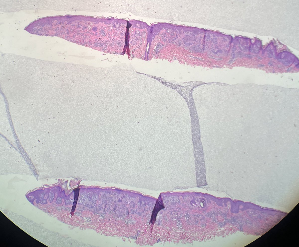 et565's tweet photo. 48 year old male, shoulder lesion #dermpath #PathTwitter #dermatology   @ArjunRamaiya1 @kis_lorand @DrGeeONE @TristanRutland7 @trishstratuscom @MarcelaSaebL @redsnapperpath @AlomariDermpath @gonzadetoro @mccalmo @david_terrano @PIorfino @ChristineJKoMD @melanopath @ClayCockerell https://t.co/P28qAQiPOO