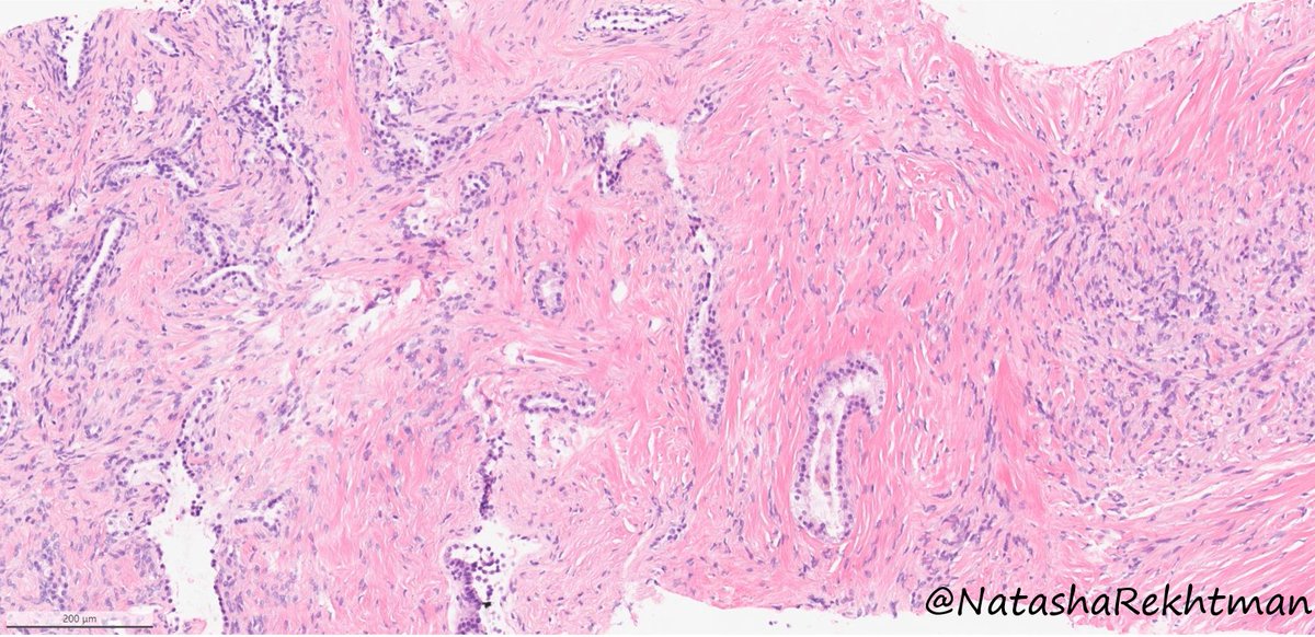natasharekhtman's tweet photo. Hi #pathology friends,

Anyone up for a #PulmPath #NatPathPuzzler? Excited to share this one.

Lung nodule. Adult. No prior history. No tricks. Sent to us as a consult asking: what is this?? https://t.co/bU2choVBaX