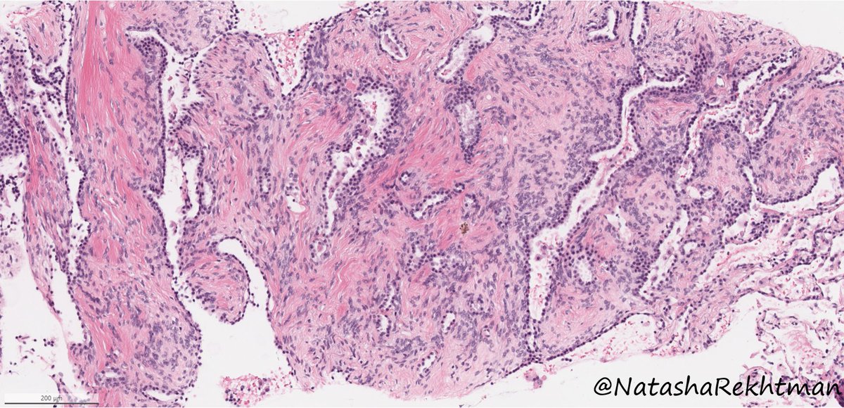 natasharekhtman's tweet photo. Hi #pathology friends,

Anyone up for a #PulmPath #NatPathPuzzler? Excited to share this one.

Lung nodule. Adult. No prior history. No tricks. Sent to us as a consult asking: what is this?? https://t.co/bU2choVBaX