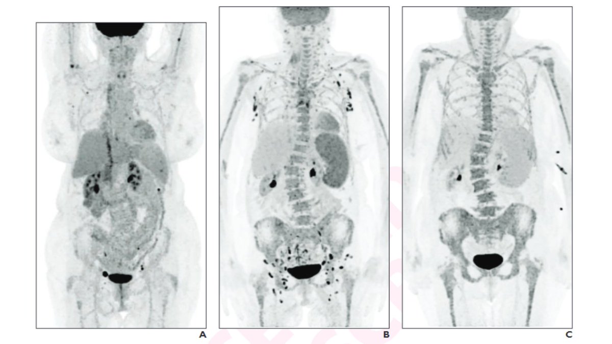 New <a href="/AJR_Radiology/">AJR</a> Accepted Manuscript:

"Role of FDG PET/CT in Patients With Lymphoma Treated With CAR T-Cell Therapy: Current Concepts"

By Dr Murad &amp; team <a href="/UofTMedIm/">UofT Medical Imaging</a> 

ajronline.org/doi/10.2214/AJ…