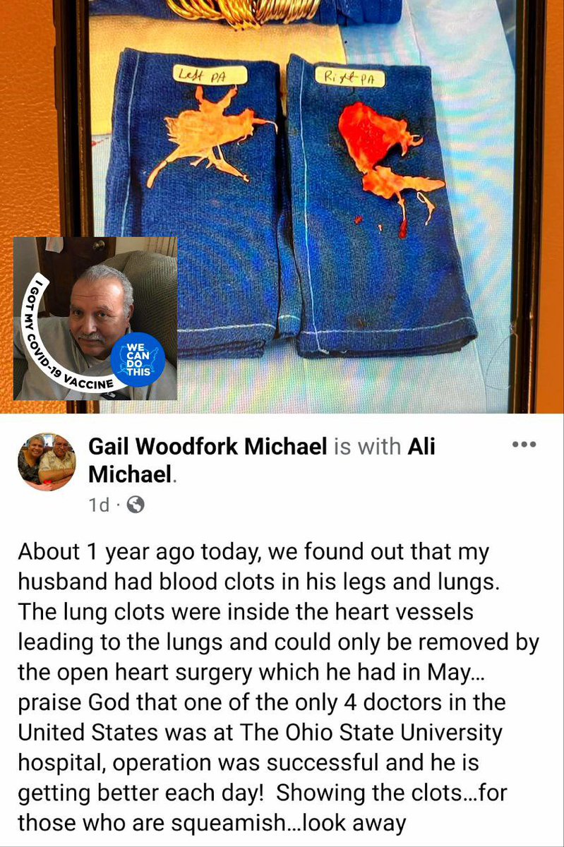 DiedSuddenly_'s tweet photo. Why are health officials not sounding the alarm on this? 

These are not blood clots. https://t.co/2TQiHJd4dl