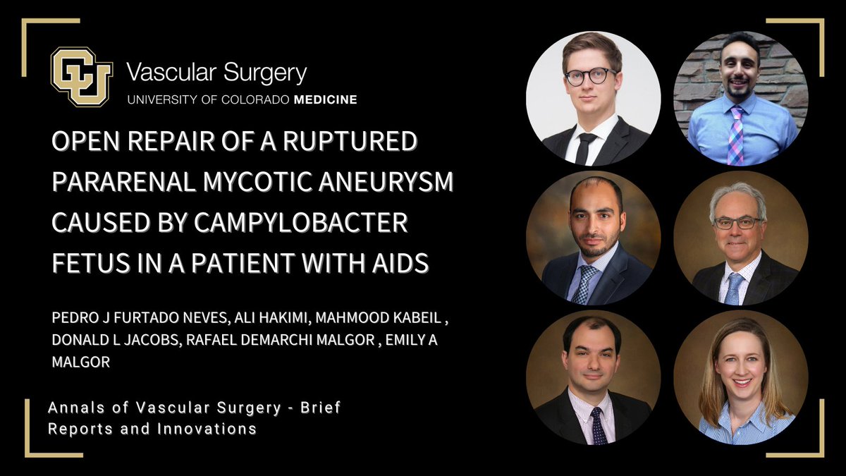Our skilled team successfully tackled a rare case of pararenal mycotic aneurysm caused by Campylobacter fetus in a 48-year-old AIDS patient.

Swift, emergent open repair and renal artery reimplantation led to a remarkable recovery. 

Congratulations to this group of experts!