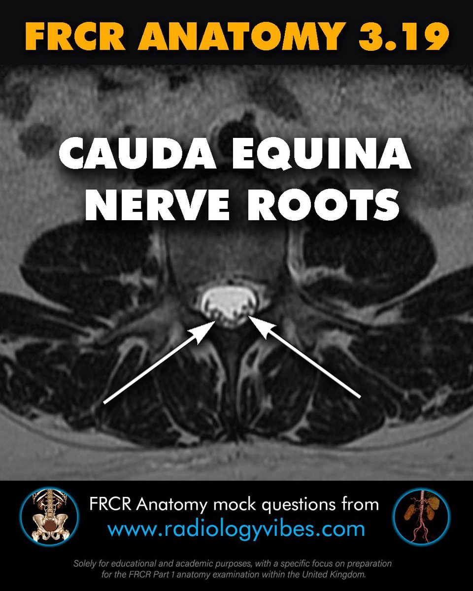 FRCR Anatomy 3.19: Cauda Equina Nerve Roots #radres #FOAMrad #FRCR #radiology #anatomy #MedTwitter #radtwitter #FRCRanatomy