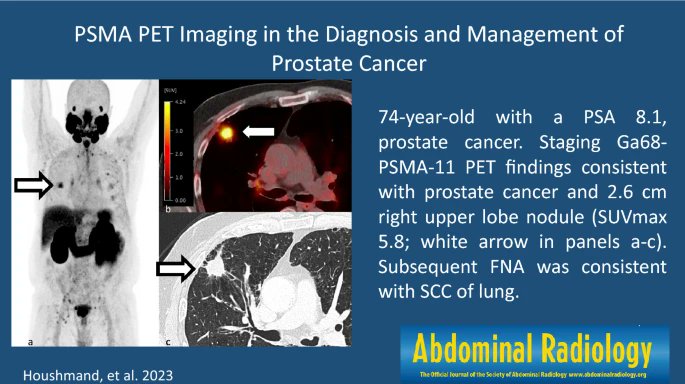 Abdominal Radiology (@abdominal_rad) on Twitter photo Graphical abstract published 7/26/2023
#abdradj #radiology <a href="/SocietyAbdRad/">Society of Abdominal Radiology | SAR</a>
PSMA PET imaging in the diagnosis and management of prostate cancer
Sina Houshmand, Courtney Lawn-Heath, Spencer Bahr
<a href="/UCSFMedicine/">UCSF School of Medicine</a>
link.springer.com/article/10.100… Graphical abstract published 7/26/2023
#abdradj #radiology <a href="/SocietyAbdRad/">Society of Abdominal Radiology | SAR</a>
PSMA PET imaging in the diagnosis and management of prostate cancer
Sina Houshmand, Courtney Lawn-Heath, Spencer Bahr
<a href="/UCSFMedicine/">UCSF School of Medicine</a>
link.springer.com/article/10.100…